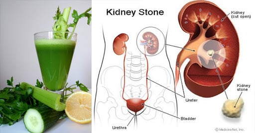 Kidney Stone Syrup Manufacturers in India